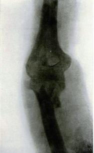 Снимок множественного перелома локтевой кости. Виден отделившийся локтевой отросток