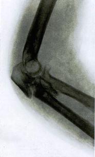 Множественный раздробленный перелом локтевого сустава