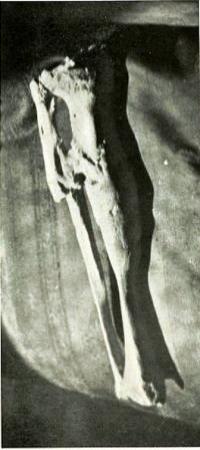 Снимок сложного перелом большеберцовой и малоберцовой костей с заметной на снимке перемычкой кости, наблюдается излечение