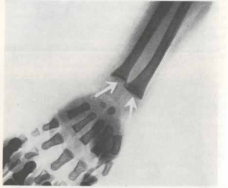 "Белая линия" на рентгене при цинге